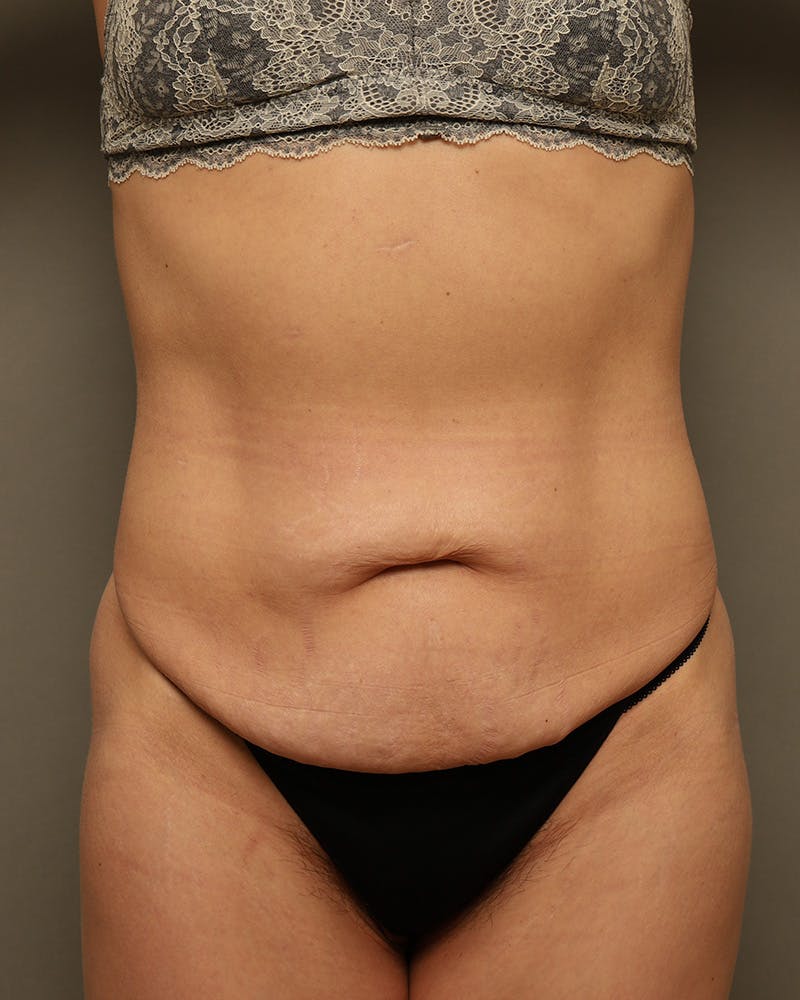 Abdominoplasty or Tummy Tuck - Salt Lake City