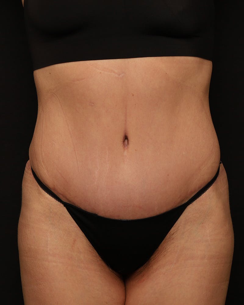 Abdominoplasty or Tummy Tuck - Salt Lake City
