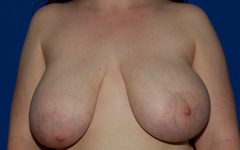 Breast Reduction Salt Lake City
