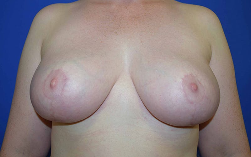 Breast Reduction Salt Lake City